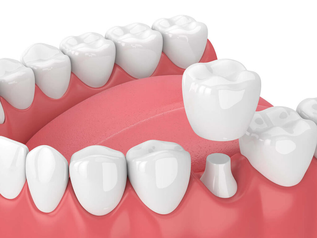 Graphic of a dental crown being placed in the mouth