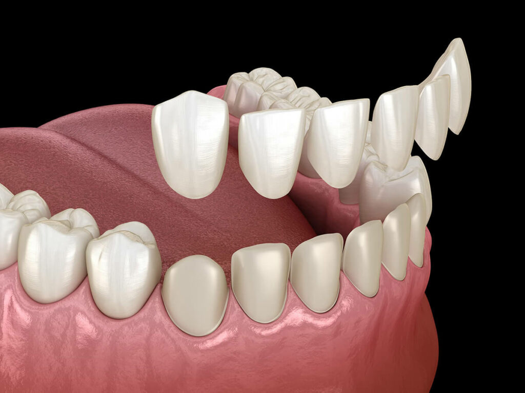 Graphic showing how veneers are placed on teeth