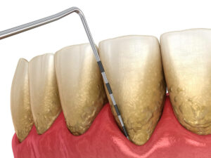 Graphic showing periodontal treatment