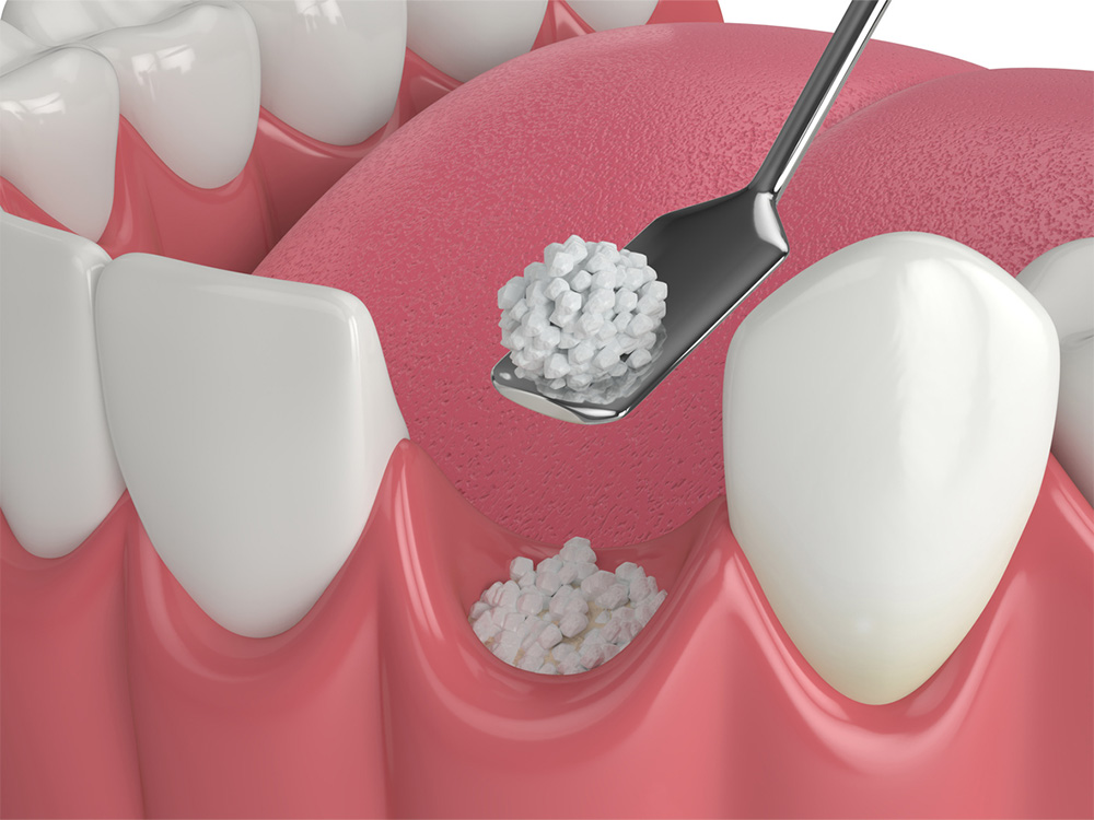 Graphic showing a bone graft procedure.