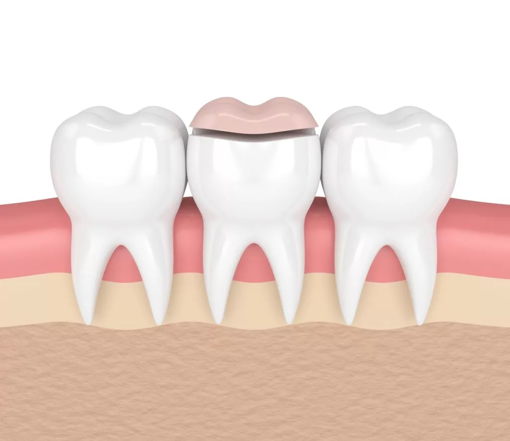 Graphic of a dental inlay