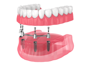 full arch dental implant graphic