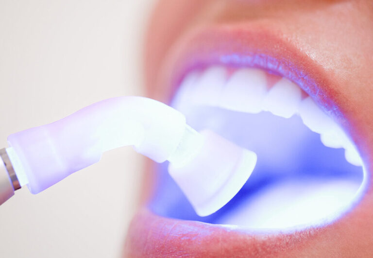 Soft tissue laser being used in the mouth