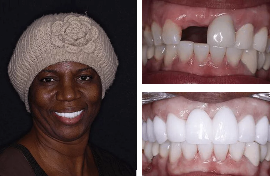 Dental implant before and after photos