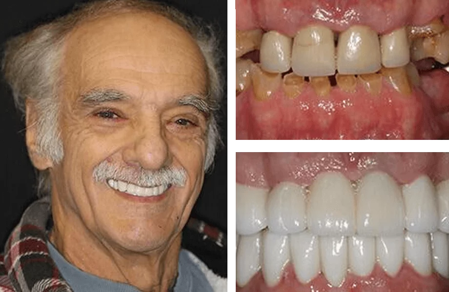 Full-mouth dental implant before and after photos.