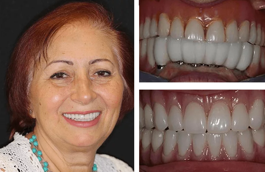 Full-mouth dental implant before and after photos.