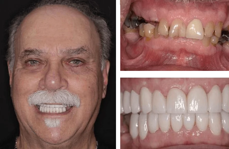 Full-mouth dental implant before and after photos.