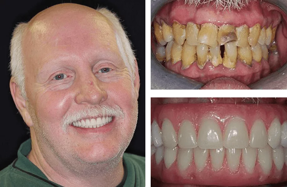 Full-mouth dental implant before and after photos.