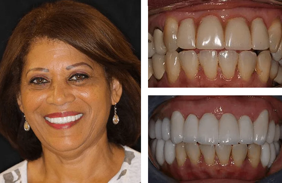 Full-mouth dental implant before and after photos.
