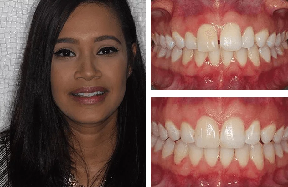 Dental veneers before and after photos.