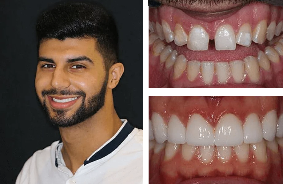 Dental veneers before and after photos.