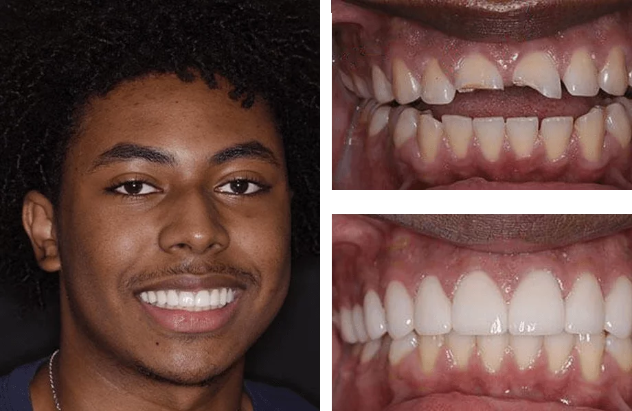 Dental veneers before and after photos.