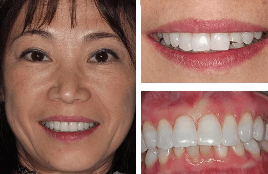 Dental veneers before and after photos.