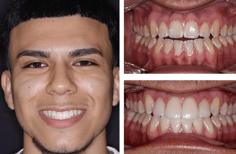 Teeth whitening before and after photos.