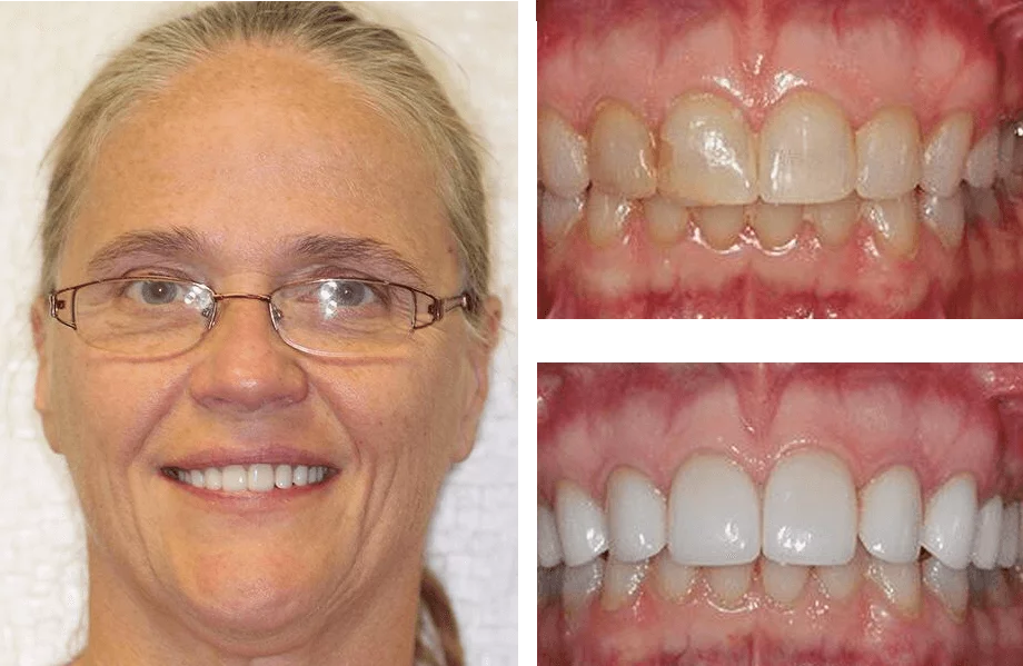 Teeth whitening before and after photos.