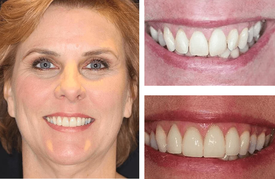 Teeth whitening before and after photos.