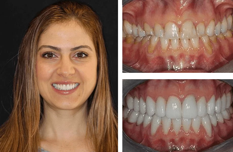 Teeth whitening before and after photos.