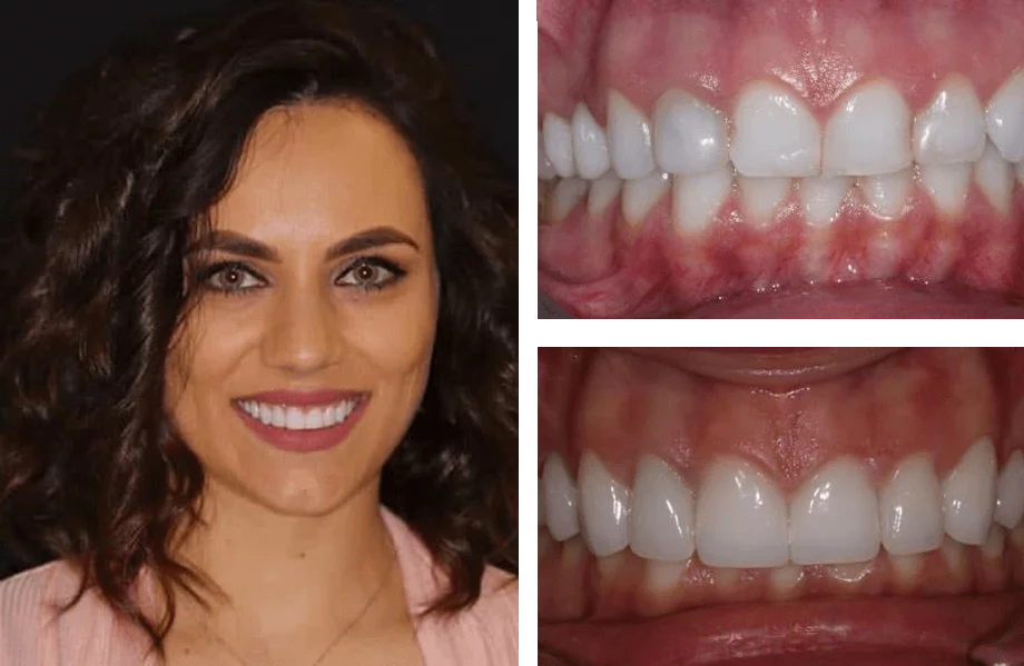 Composite image showing a smiling person with curly dark hair and light eyes on the left, wearing a light pink top. The right side features two close-ups of their teeth, with the top image highlighting gum lines and alignment, and the bottom image focusing on spacing and dental aesthetics.