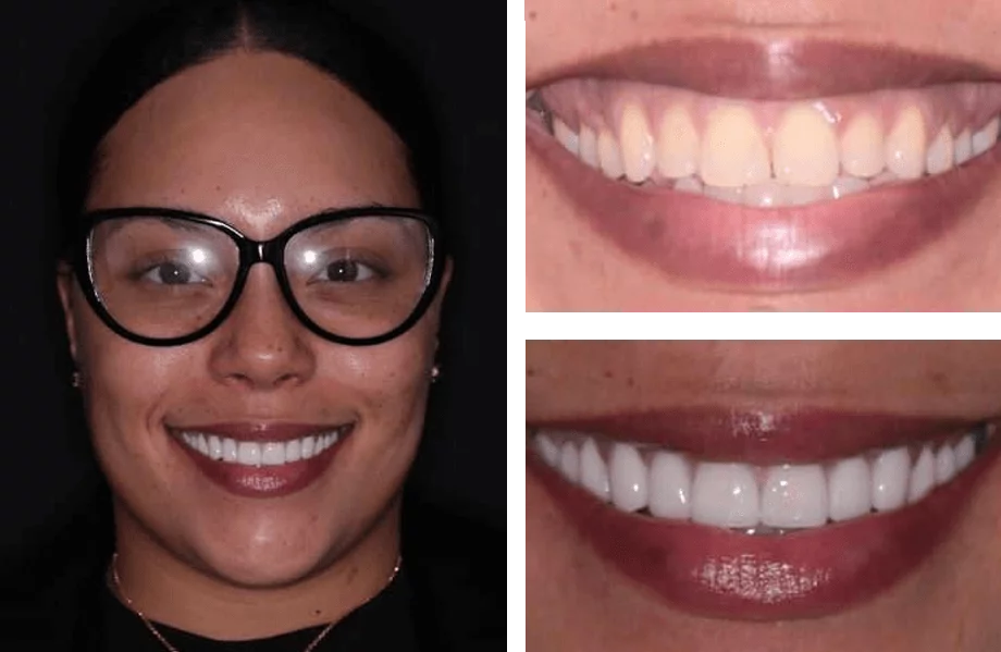 Side-by-side comparison showing a smiling person in black-framed glasses on the left and two close-ups of their teeth on the right. The top right shows yellowed, uneven teeth before treatment; the bottom right reveals bright, uniform teeth after cosmetic dental work.