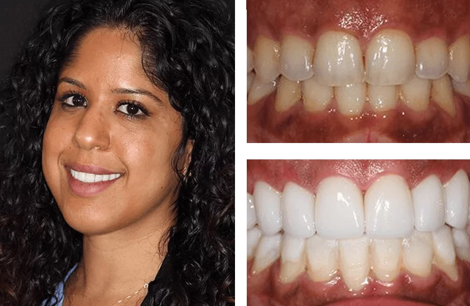 Split image showing a smiling person with curly hair on the left and two close-ups of their teeth on the right. The top right shows natural teeth with discoloration; the bottom right reveals whiter, more uniform teeth after cosmetic dental treatment.