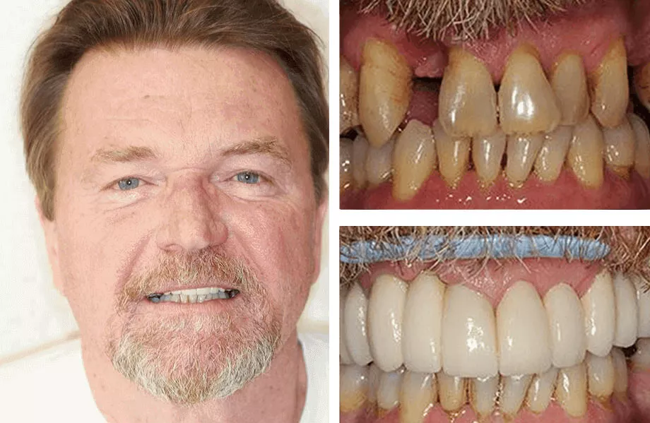 Collage showing a middle-aged man smiling on the left and two close-up images of his teeth on the right. The top right shows discolored, worn teeth before treatment; the bottom right reveals straight, white teeth after dental restoration.