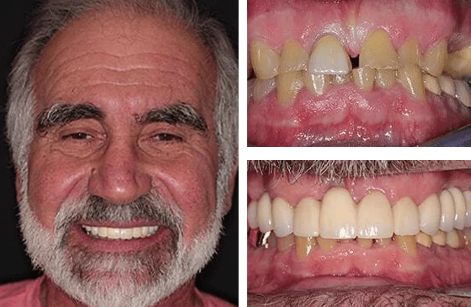 Composite image showing an older person smiling on the left and two close-up shots of their teeth on the right. The top right shows discolored, misaligned teeth before treatment; the bottom right reveals improved alignment and color after dental restoration.