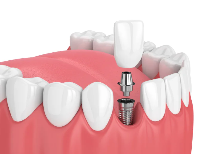 Single-Tooth Dental Implants in Harriman, NY at Harriman Dental